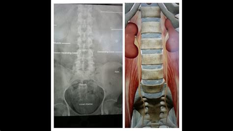 kubmedical abbreviation|Kidney, Ureter, Bladder X.